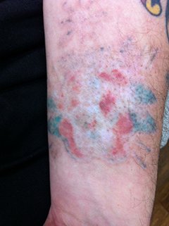Tattoo Removal - Don’t try this at home! - First Impressions Laser