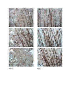 Sandy�s Microscopic Before and After Images Hair Loss Treatments
