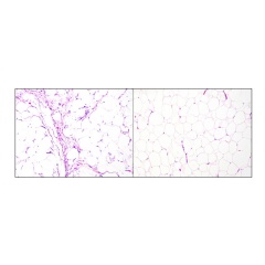 Atypical lipomatous tumor/well-differentiated liposarcoma (left-hand); lipoma (right-hand) (Credit: Tony Ng, MD, PhD, The University of British Columbia).