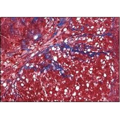 Caption: A stained micrograph of 3D primary human liver cell tissue modeling MASH. Areas of fibrosis are indicated in blue (Credit: Viscient Biosciences).