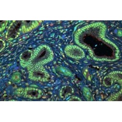 The growth protein, MYC, was consistently found with RBM42, which spurs MYC production, in human pancreatic tumors. Above, microscopy for MYC (red) and RBM42 (green) (see complete caption below)