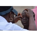 Global population requiring interventions against trachoma falls below 100 million for the first time